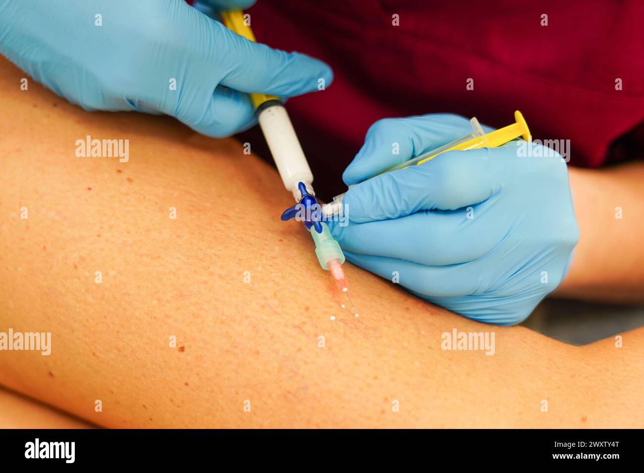Enlèvement des varices sur les jambes. Docteur en sclérothérapie Banque D'Images