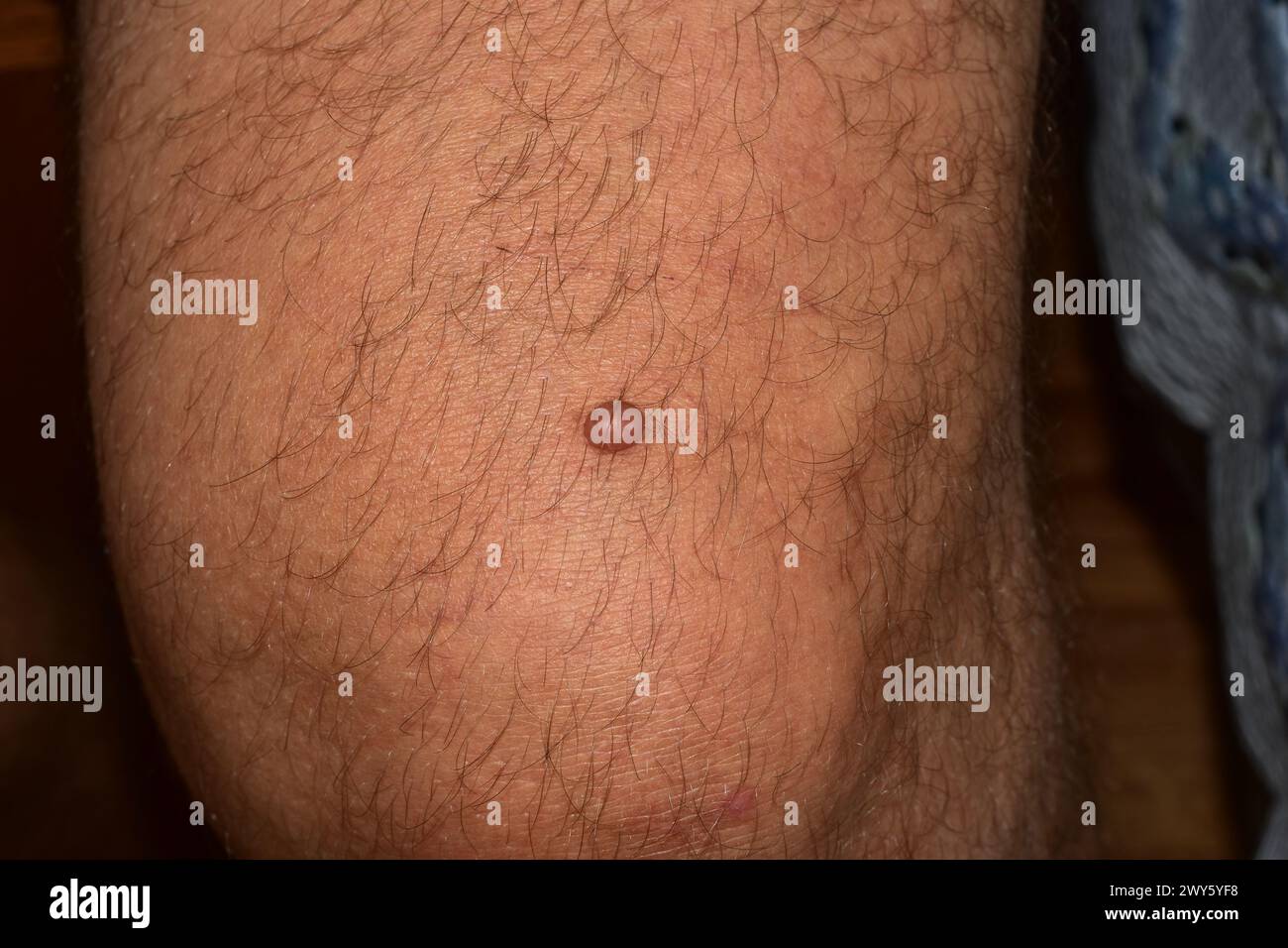 La photo montre le genou d'un homme avec un papillome rond. Banque D'Images