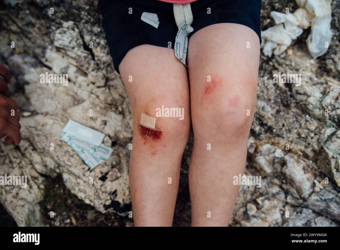 Gros plan du genou écorché de l'enfant avec des bandages et des enveloppements. Banque D'Images