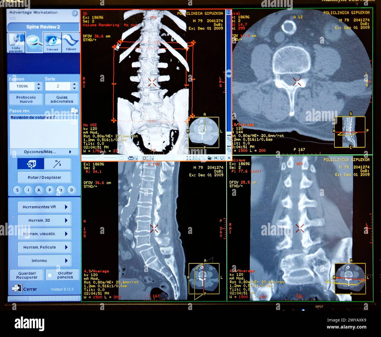 Acquisition HD (haute définition) de la colonne vertébrale, CAT, imagerie médicale pour le diagnostic. Hôpital Policlinica Gipuzkoa, Saint-Sébastien, Donostia, Euskadi, Espagne. Banque D'Images