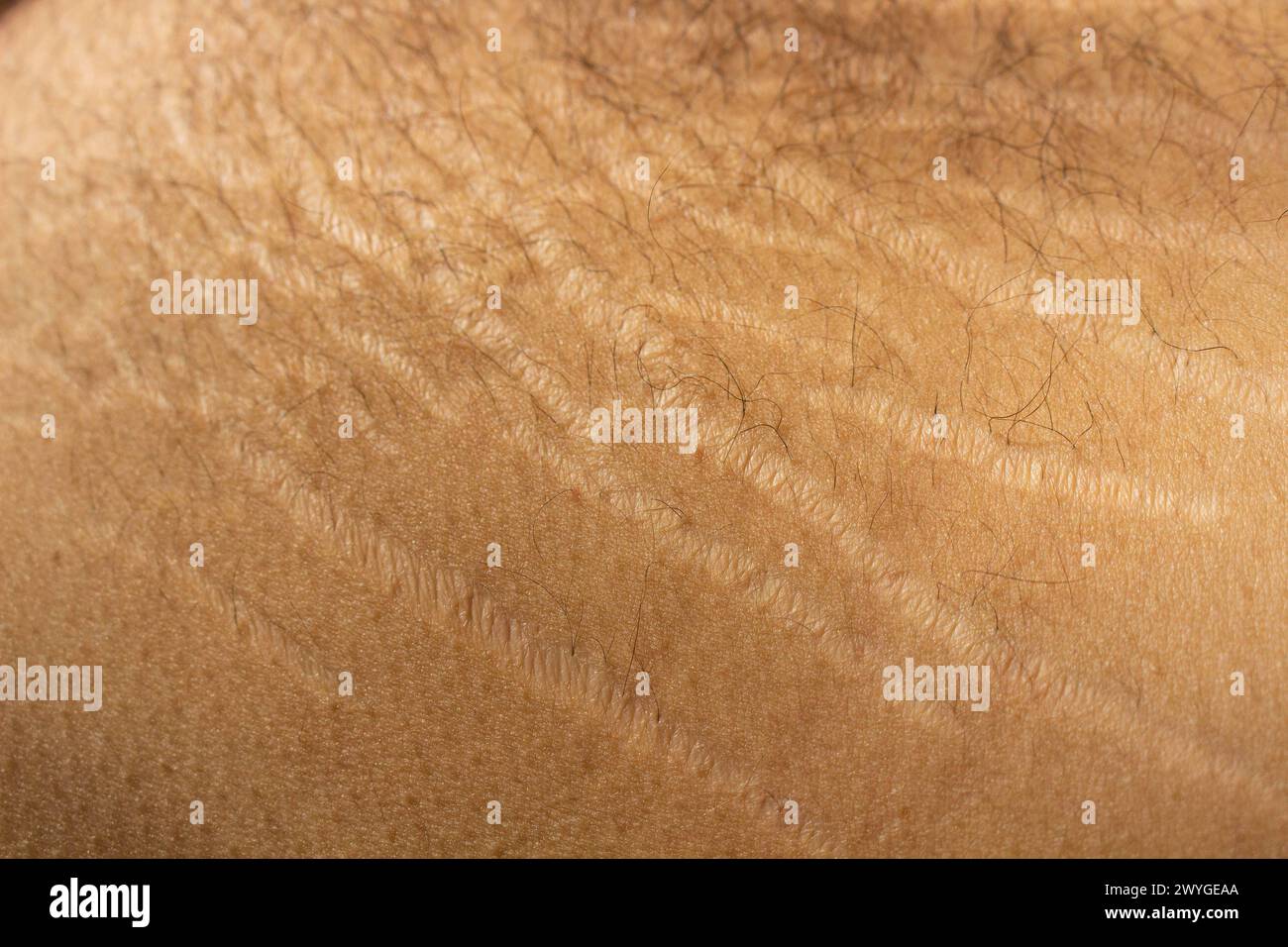 Explorez l'impact des changements de poids, y compris l'obésité et le gain musculaire, sur le corps masculin à travers cette image captivante capturant les vergetures Banque D'Images