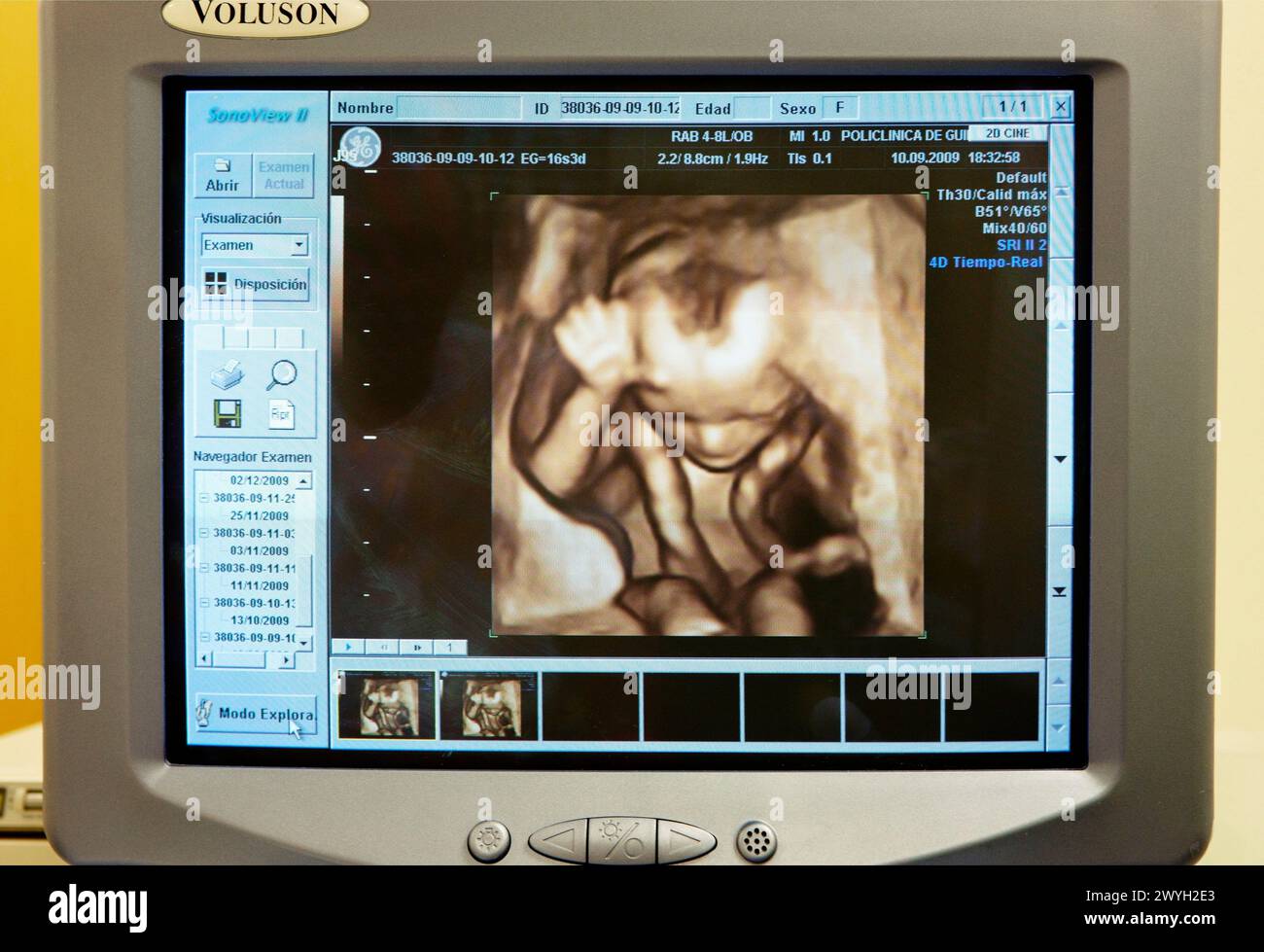 Échographie obstétricale 3D d'un fœtus, scanner de bébé 4D montrant le mouvement, gynécologie, Hôpital Policlinica Gipuzkoa, San Sebastian, Donostia, Euskadi, Espagne. Banque D'Images