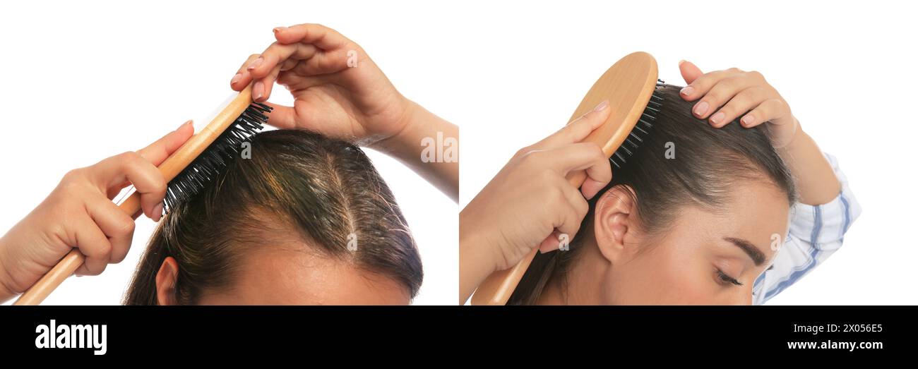 Femme avant et après le traitement des cheveux avec le dispositif darsonval à haute fréquence sur fond blanc, gros plan. Collage de photos Banque D'Images