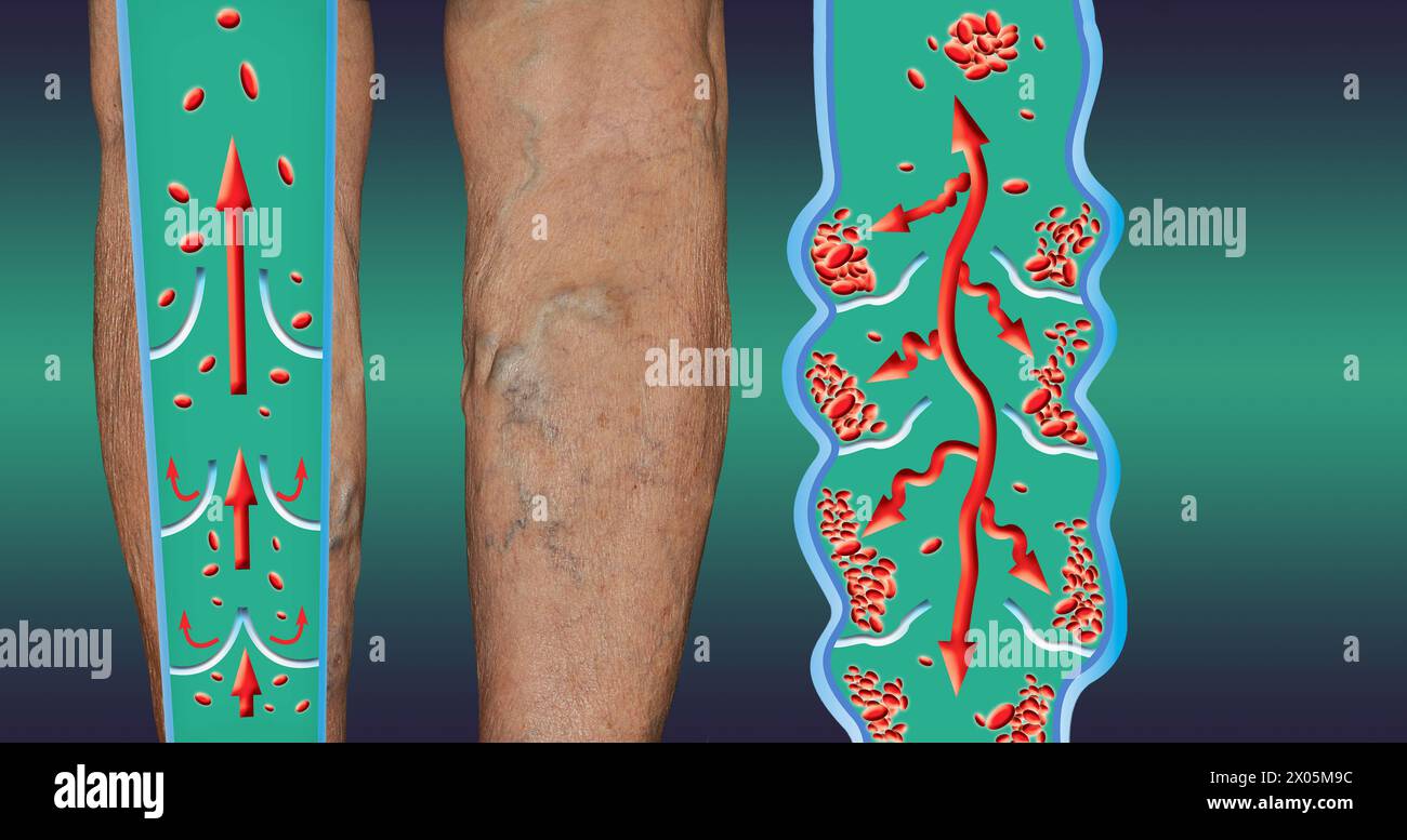 Thrombose veineuse profonde ou des caillots de sang. Embolie gazeuse. Structure de la normale et les varices veines femelle Banque D'Images