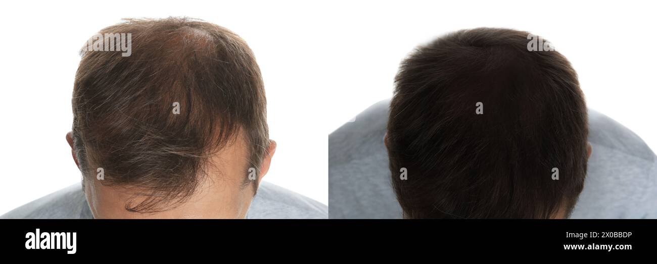 Homme avant et après le traitement des cheveux avec le dispositif darsonval à haute fréquence sur fond blanc, gros plan. Collage de photos Banque D'Images