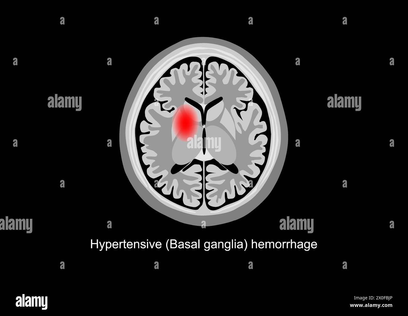 Image illustrative représentant une hémorragie hypertensive dans la région des ganglions de la base du cerveau. Illustration de Vecteur