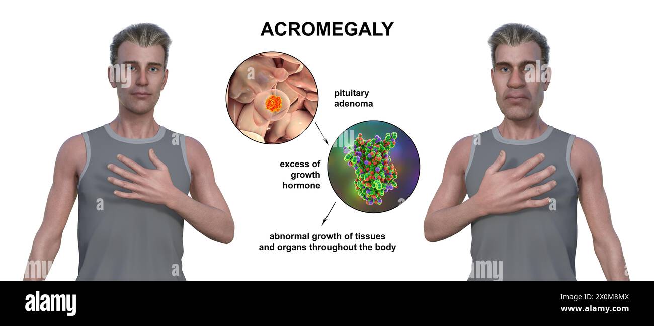 Illustration 3D comparant un homme en bonne santé (à gauche) et le même homme acromégalique (à droite). L'acromégalie est une condition provoquant une augmentation de la taille des mains et du visage due à la surproduction de somatotrophine (hormone de croissance humaine). Elle résulte généralement de la formation d'une tumeur bénigne (adénome) sur l'hypophyse. Banque D'Images
