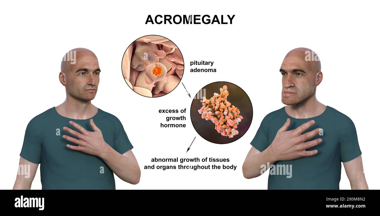 Illustration 3D comparant un homme en bonne santé (à gauche) et le même homme acromégalique (à droite). L'acromégalie est une condition provoquant une augmentation de la taille des mains et du visage due à la surproduction de somatotrophine (hormone de croissance humaine). Elle résulte généralement de la formation d'une tumeur bénigne (adénome) sur l'hypophyse. Banque D'Images