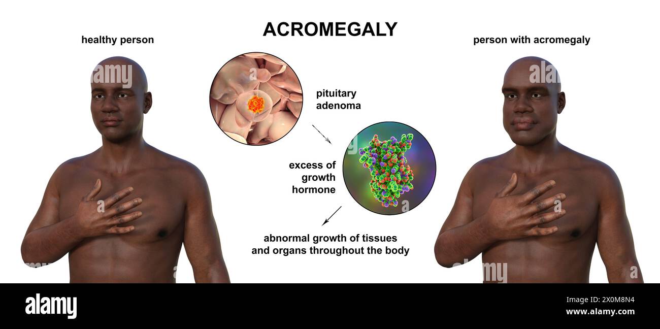 Illustration 3D comparant un homme en bonne santé (à gauche) et le même homme acromégalique (à droite). L'acromégalie est une condition provoquant une augmentation de la taille des mains et du visage due à la surproduction de somatotrophine (hormone de croissance humaine). Elle résulte généralement de la formation d'une tumeur bénigne (adénome) sur l'hypophyse. Banque D'Images