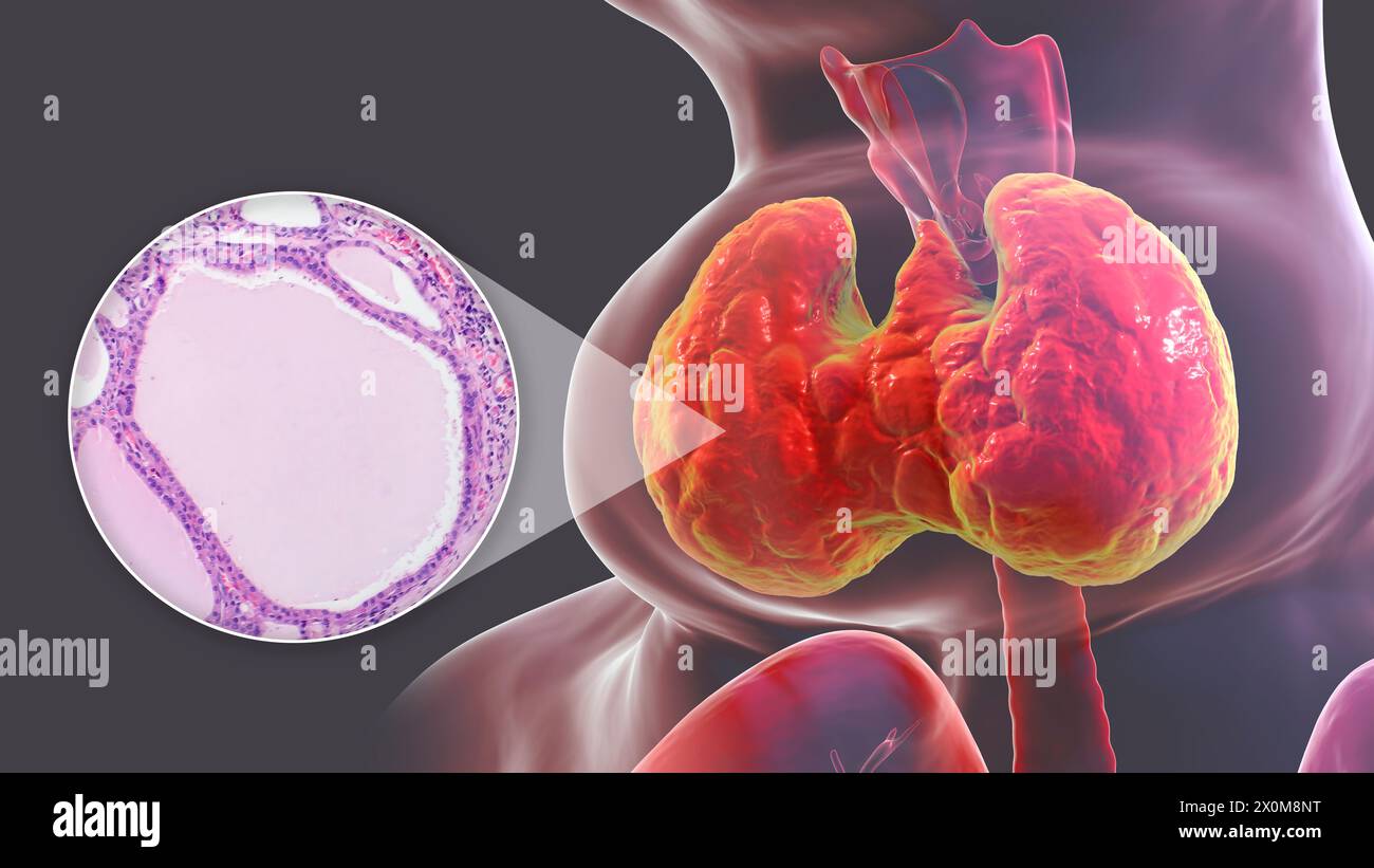 Illustration 3D d'une personne atteinte d'un goitre endémique (hypertrophie de la glande thyroïde, base du cou) et gros plan du tissu thyroïdien affecté. Les goitres endémiques sont causés par un manque d'iode. Elle est considérée comme endémique lorsqu'elle est présente dans plus de 5 % de la population d'une région donnée, ou plus de 10 % de la population scolaire. Banque D'Images