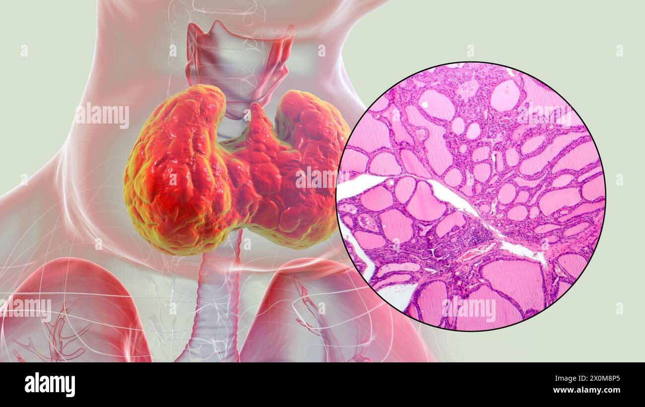 Illustration 3D d'une personne atteinte d'un goitre toxique (hypertrophie de la glande thyroïde, base du cou) et gros plan du tissu thyroïdien affecté. Un goitre est considéré comme toxique lorsque la glande thyroïde élargie produit également une quantité excessive d'hormones thyroïdiennes. Banque D'Images