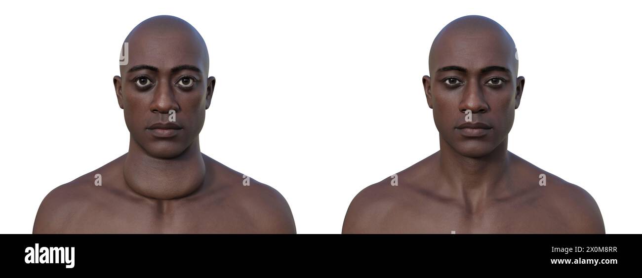 Illustration 3D d'un homme avec une glande thyroïde élargie (goitre, base du cou) et une protrusion anormale des yeux (exophtalmie), et le même homme avec une thyroïde et des yeux sains pour comparaison (à droite). Ce sont deux symptômes d'une hyperactivité de la glande thyroïde, connue sous le nom d'hyperthyroïdie. Banque D'Images