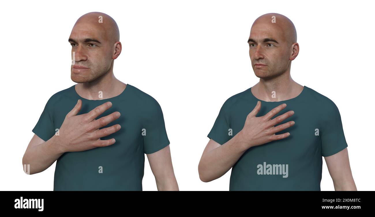 Illustration 3D comparant un homme atteint d'acromégalie (à gauche) et le même homme en bonne santé (à droite). L'acromégalie est une condition provoquant une augmentation de la taille de diverses parties du corps, y compris les traits du visage. Elle est causée par la surproduction de somatotrophine (hormone de croissance humaine) résultant généralement d’une tumeur bénigne (adénome) se formant sur l’hypophyse. Banque D'Images