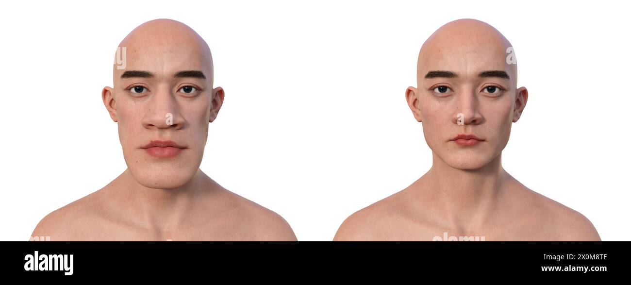 Illustration 3D comparant un homme atteint d'acromégalie (à gauche) et le même homme en bonne santé (à droite). L'acromégalie est une condition provoquant une augmentation de la taille de diverses parties du corps, y compris les traits du visage. Elle est causée par la surproduction de somatotrophine (hormone de croissance humaine) résultant généralement d’une tumeur bénigne (adénome) se formant sur l’hypophyse. Banque D'Images