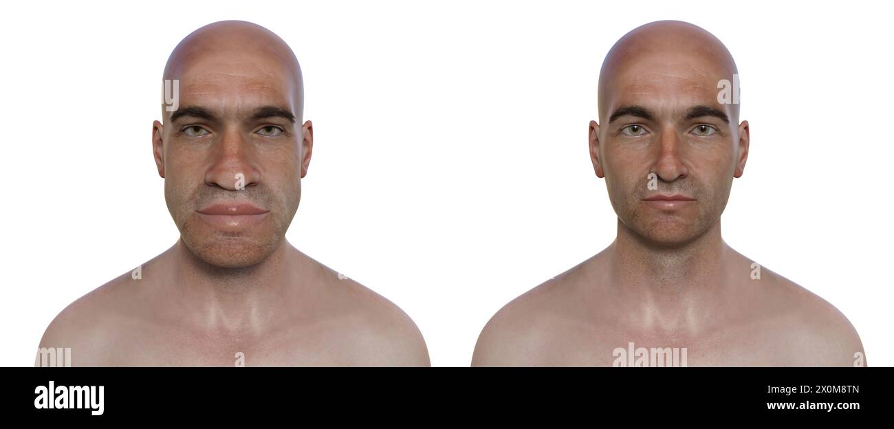 Illustration 3D comparant un homme atteint d'acromégalie (à gauche) et le même homme en bonne santé (à droite). L'acromégalie est une condition provoquant une augmentation de la taille de diverses parties du corps, y compris les traits du visage. Elle est causée par la surproduction de somatotrophine (hormone de croissance humaine) résultant généralement d’une tumeur bénigne (adénome) se formant sur l’hypophyse. Banque D'Images