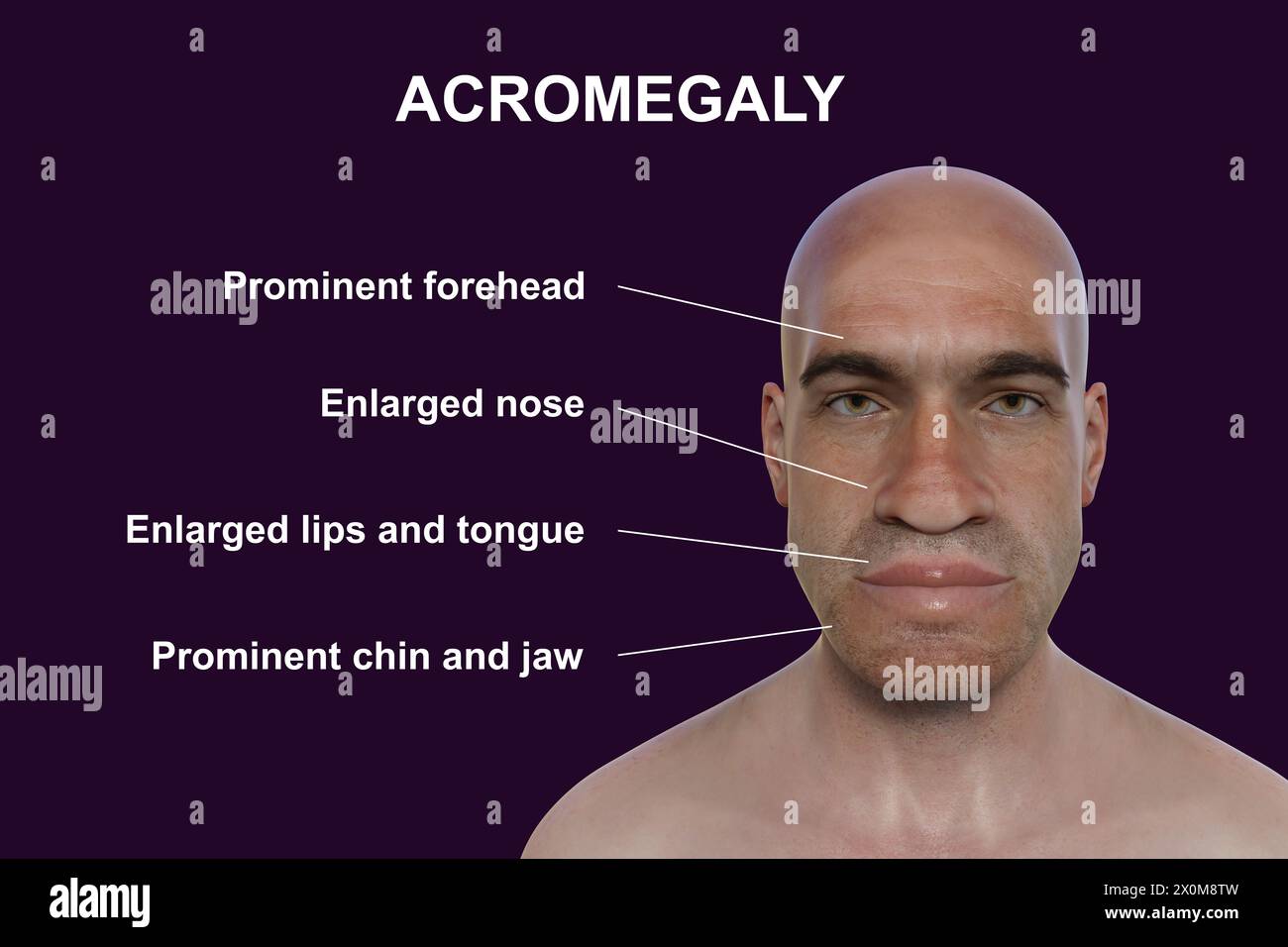 Illustration 3D d'un homme atteint d'acromégalie. C'est une condition provoquant une augmentation de la taille des mains et du visage due à la surproduction de somatotrophine (hormone de croissance humaine). Elle résulte généralement de la formation d'une tumeur bénigne (adénome) sur l'hypophyse. Banque D'Images