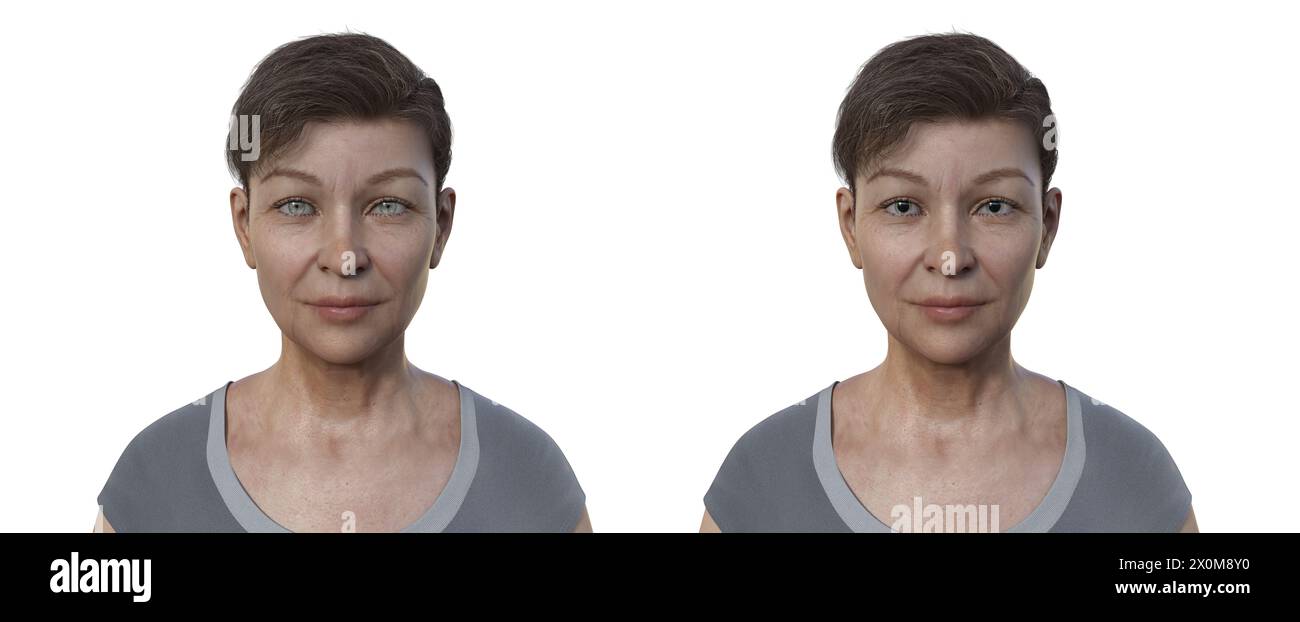 Illustration représentant une femme avec des pupilles rétrécies (à gauche) et dilatées (à droite) et oculaires. Banque D'Images