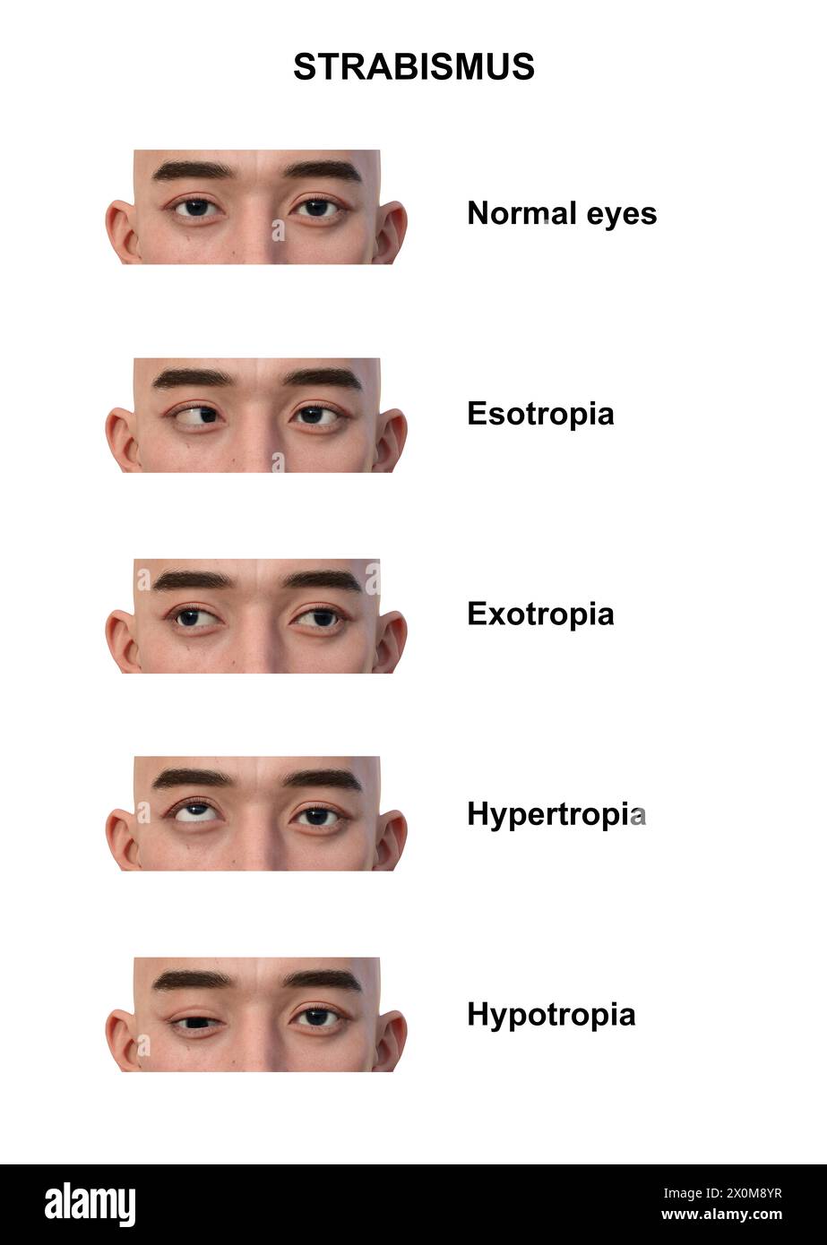 Illustration d'un homme avec différents types de strabisme : ésotropie, exotropie, hypertropie et hypotropie. Banque D'Images