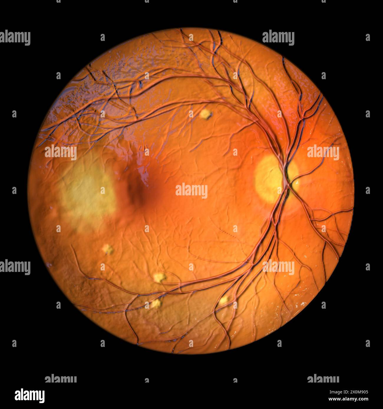 Illustration d'une rétine atteinte de blastomycose vue en ophtalmoscopie. Il s’agit d’une infection causée par les champignons Blastomyces dermatitidis. La rétine présente des infiltrats choroïdiens jaunes dispersés et une lésion de masse choroïdienne. Banque D'Images