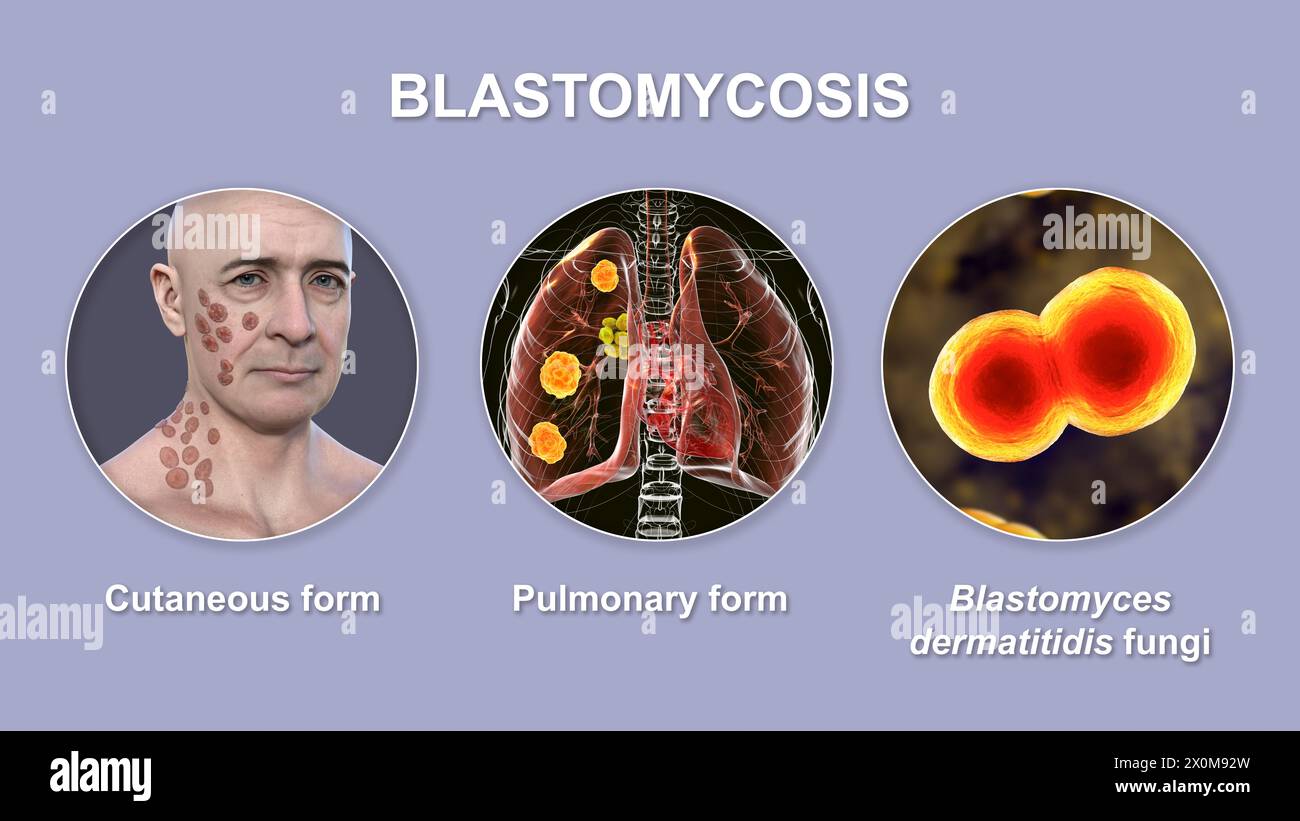 Illustration 3D montrant deux présentations cliniques de blastomycose et une vue rapprochée des champignons Blastomyces dermatitidis. La blastomycose est une infection fongique qui peut survenir lorsque les spores de Blastomyces dermatitidis sont inhalées. L'infection affecte principalement les poumons (pulmonaires), certains patients développant également des symptômes cutanés (cutanés) tels que des lésions. Banque D'Images