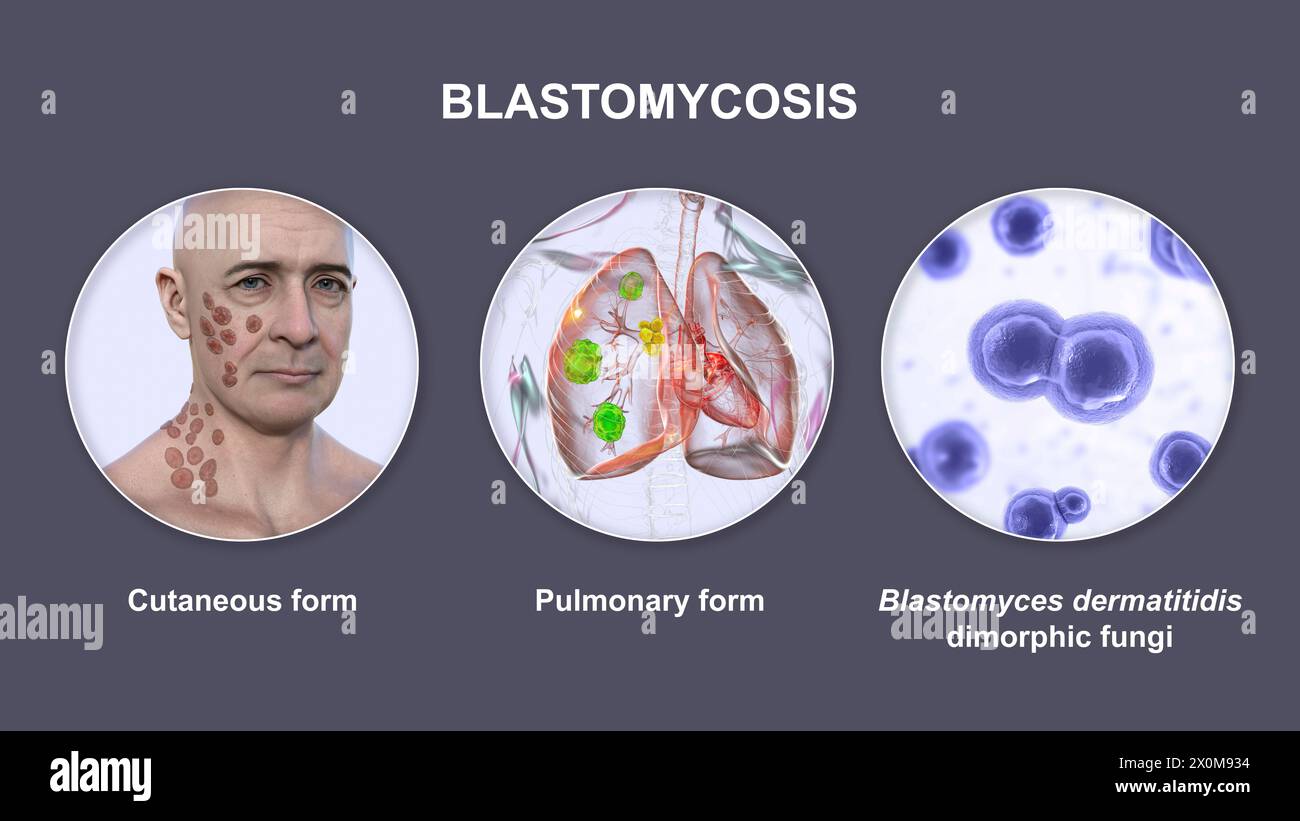 Illustration 3D montrant deux présentations cliniques de blastomycose et une vue rapprochée des champignons Blastomyces dermatitidis. La blastomycose est une infection fongique qui peut survenir lorsque les spores de Blastomyces dermatitidis sont inhalées. L'infection affecte principalement les poumons (pulmonaires), certains patients développant également des symptômes cutanés (cutanés) tels que des lésions. Banque D'Images