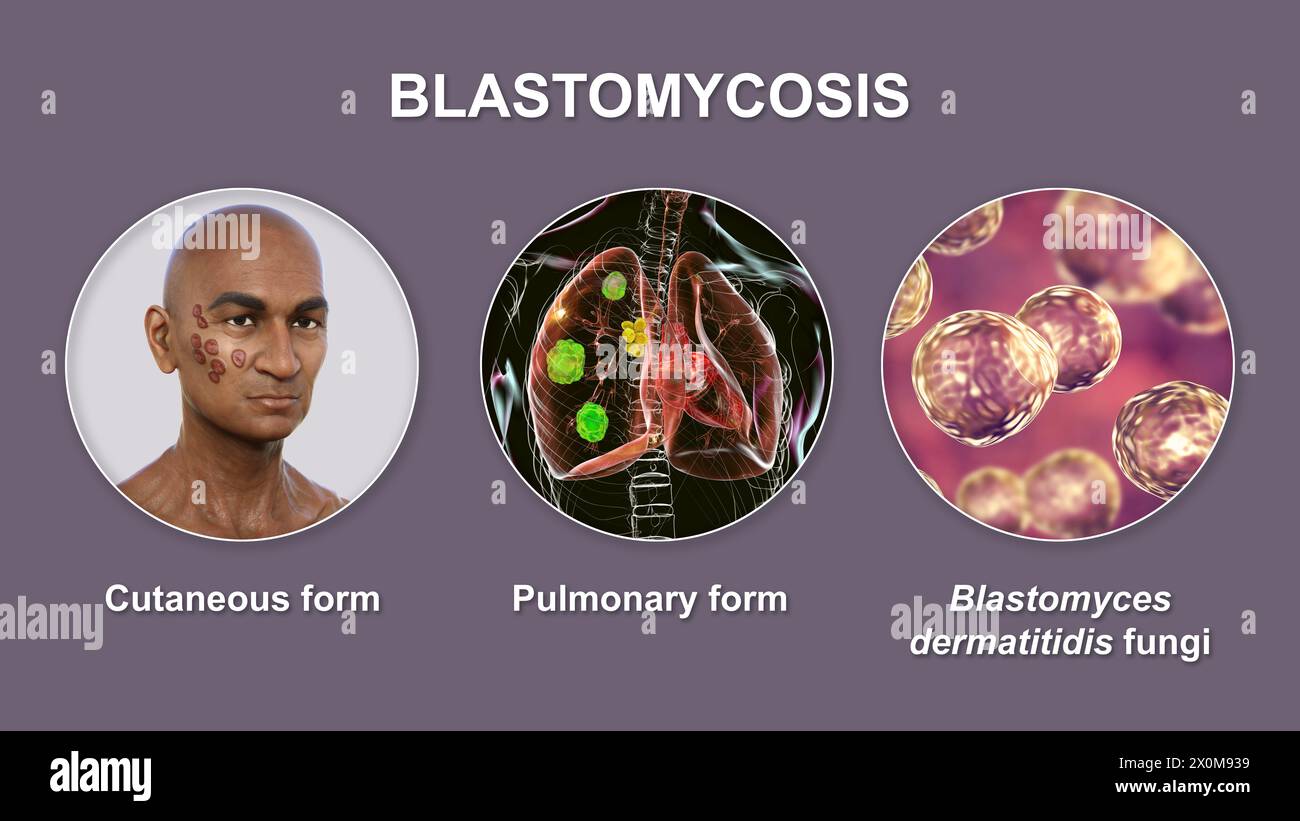 Illustration 3D montrant deux présentations cliniques de blastomycose et une vue rapprochée des champignons Blastomyces dermatitidis. La blastomycose est une infection fongique qui peut survenir lorsque les spores de Blastomyces dermatitidis sont inhalées. L'infection affecte principalement les poumons (pulmonaires), certains patients développant également des symptômes cutanés (cutanés) tels que des lésions. Banque D'Images