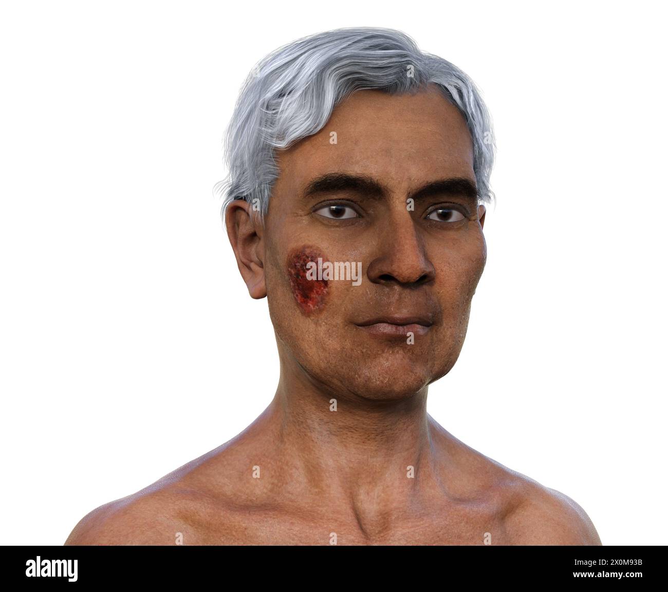 Illustration 3D d'un homme avec de multiples lésions du visage et du cou causées par une blastomycose, une infection fongique causée par les spores de Blastomyces dermatitidis. La blastomycose est souvent asymptomatique, mais peut causer des problèmes pulmonaires. Dans certains cas, de telles lésions se développent sur la peau (blastomycose cutanée) pouvant entraîner des cicatrices irréversibles. Banque D'Images