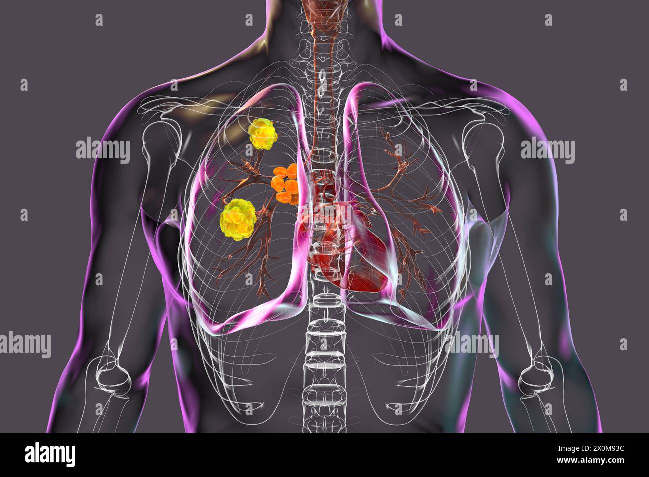 Illustration 3D d'une blastomycose pulmonaire, infection pulmonaire fongique causée par l'inhalation de spores de Blastomyces dermatitidis. La blastomycose est souvent asymptomatique, mais elle peut causer des lésions pulmonaires (jaune) et une hypertrophie des ganglions lymphatiques bronchiques (orange). Banque D'Images