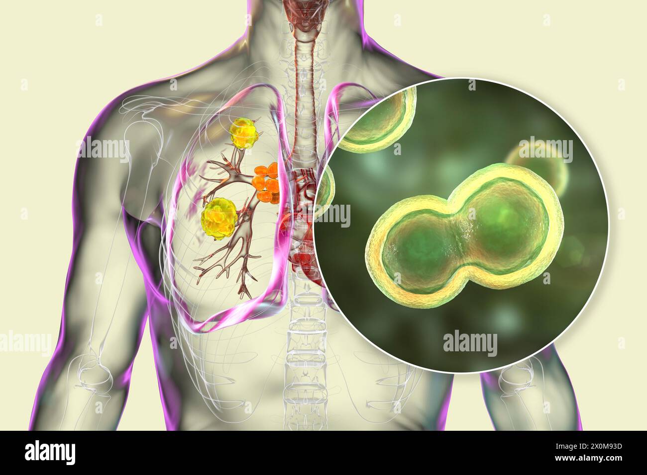 Illustration 3D de la blastomycose pulmonaire et gros plan sur le champignon responsable, Blastomyces dermatitidis. La blastomycose est souvent asymptomatique, mais elle peut causer des lésions pulmonaires (jaune) et une hypertrophie des ganglions lymphatiques bronchiques (orange). Banque D'Images
