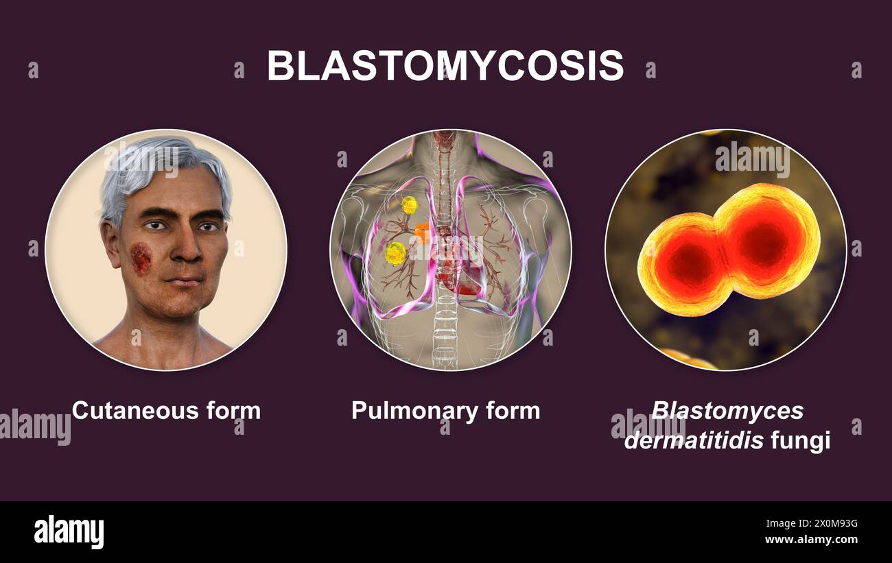 Illustration 3D montrant deux présentations cliniques de blastomycose et une vue rapprochée des champignons Blastomyces dermatitidis. La blastomycose est une infection fongique qui peut survenir lorsque les spores de Blastomyces dermatitidis sont inhalées. L'infection affecte principalement les poumons (pulmonaires), certains patients développant également des symptômes cutanés (cutanés) tels que des lésions. Banque D'Images
