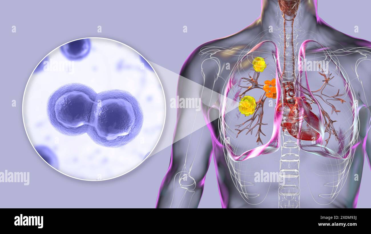 Illustration 3D de la blastomycose pulmonaire et gros plan sur le champignon responsable, Blastomyces dermatitidis. La blastomycose est souvent asymptomatique, mais elle peut causer des lésions pulmonaires (jaune) et une hypertrophie des ganglions lymphatiques bronchiques (orange). Banque D'Images