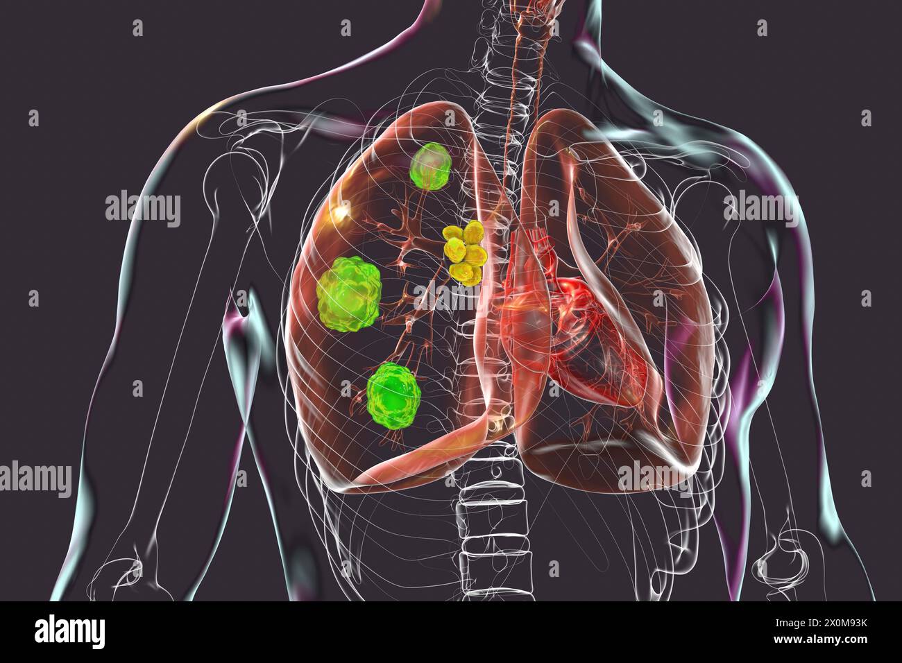Illustration 3D d'une blastomycose pulmonaire, infection pulmonaire fongique causée par l'inhalation de spores de Blastomyces dermatitidis. La blastomycose est souvent asymptomatique, mais elle peut causer des lésions pulmonaires (vert) et une hypertrophie des ganglions lymphatiques bronchiques (jaune). Banque D'Images