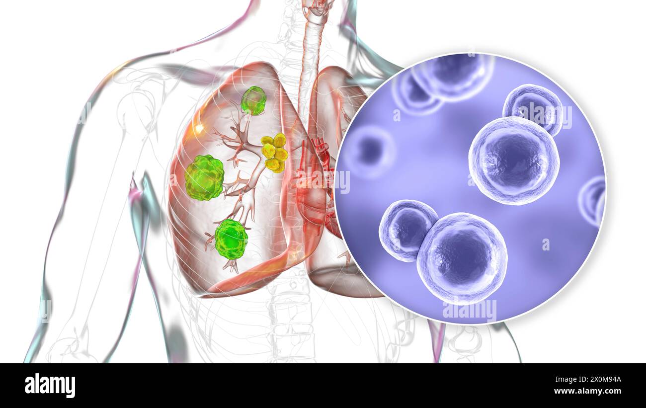 Illustration 3D de la blastomycose pulmonaire et gros plan sur le champignon responsable, Blastomyces dermatitidis. La blastomycose est souvent asymptomatique, mais elle peut causer des lésions pulmonaires (vert) et une hypertrophie des ganglions lymphatiques bronchiques (jaune). Banque D'Images