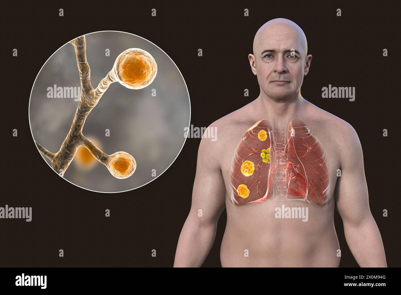 Illustration 3D de la blastomycose pulmonaire et gros plan sur le champignon responsable, Blastomyces dermatitidis. La blastomycose est souvent asymptomatique, mais elle peut causer des lésions pulmonaires (orange) et une hypertrophie des ganglions lymphatiques bronchiques (jaune). Banque D'Images