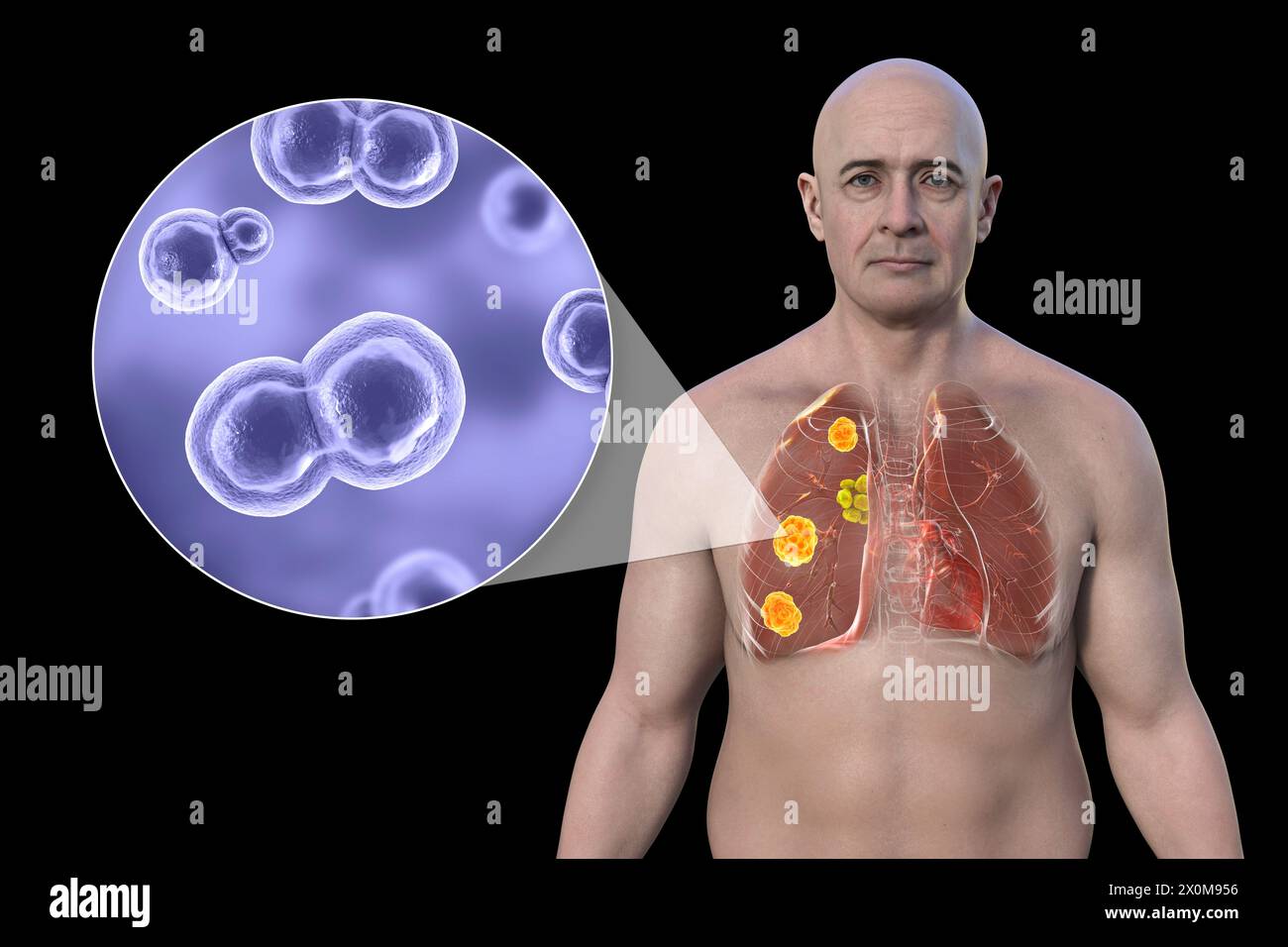 Illustration 3D de la blastomycose pulmonaire et gros plan sur le champignon responsable, Blastomyces dermatitidis. La blastomycose est souvent asymptomatique, mais elle peut causer des lésions pulmonaires (orange) et une hypertrophie des ganglions lymphatiques bronchiques (jaune). Banque D'Images