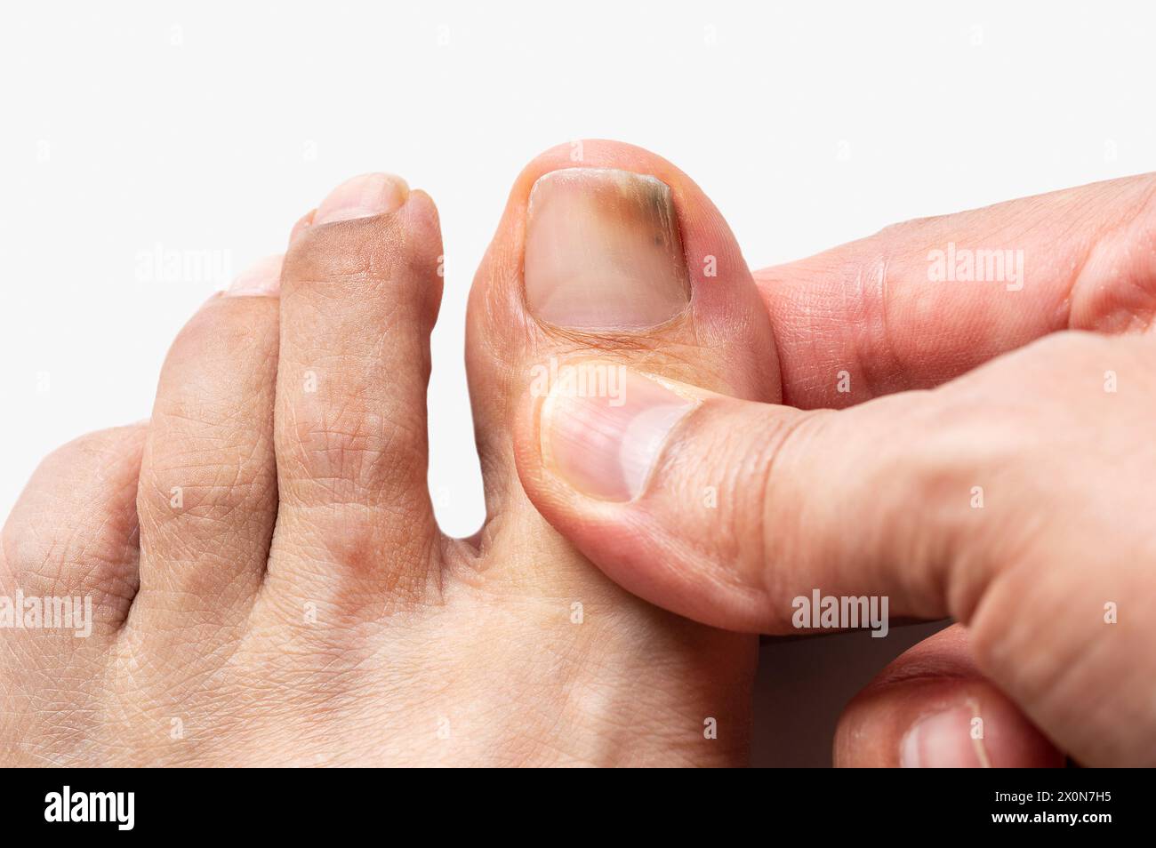 Jeune homme touchant l'ongle avec fond blanc. En regardant le champignon de l'orteil de l'autre. Banque D'Images