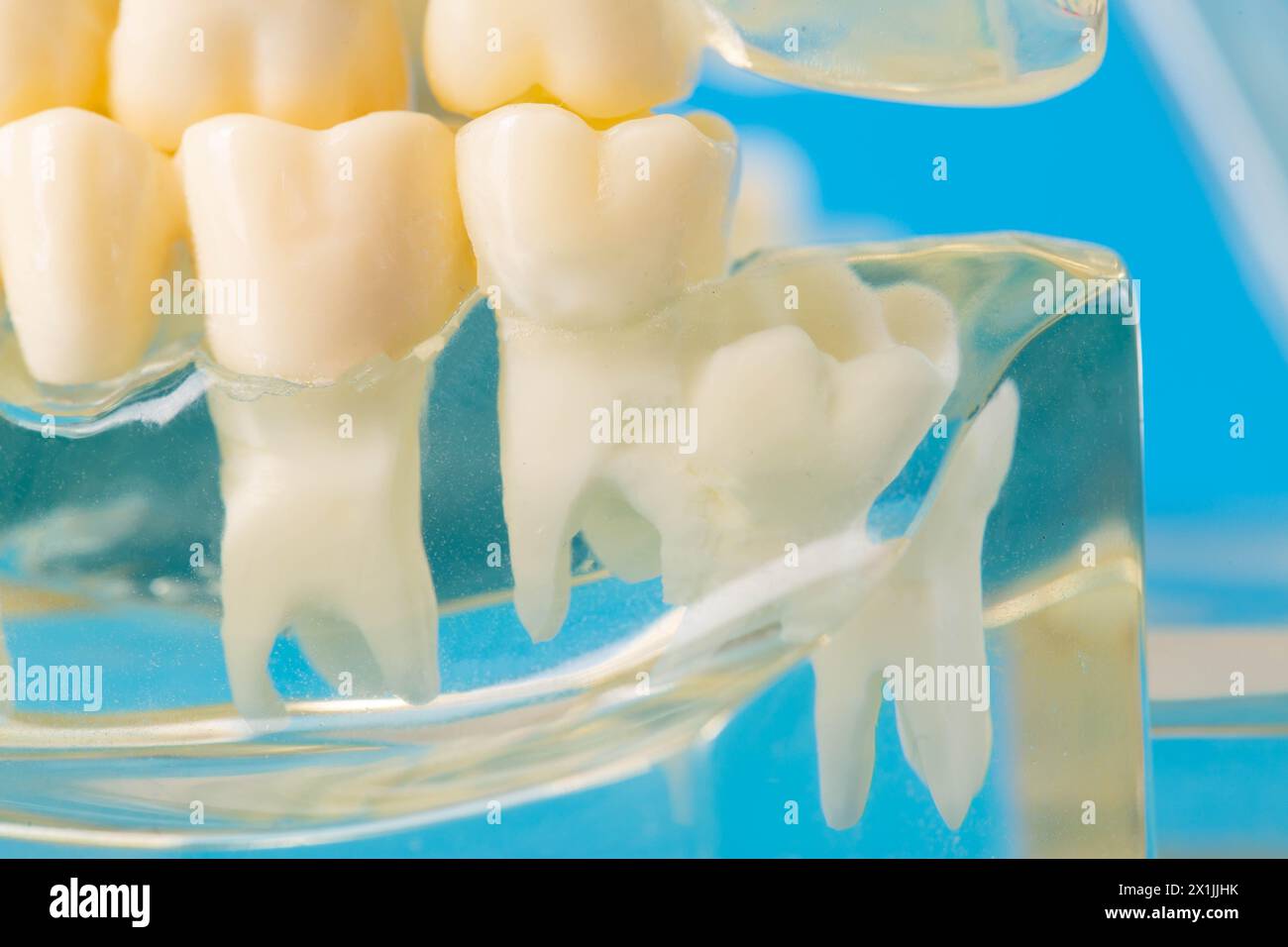Modèle de mâchoire dentaire médicale avec dents de sagesse éclatées. Inflammation des gencives près de la molaire, enlèvement des dents de sagesse. Péricoronite, macro Banque D'Images