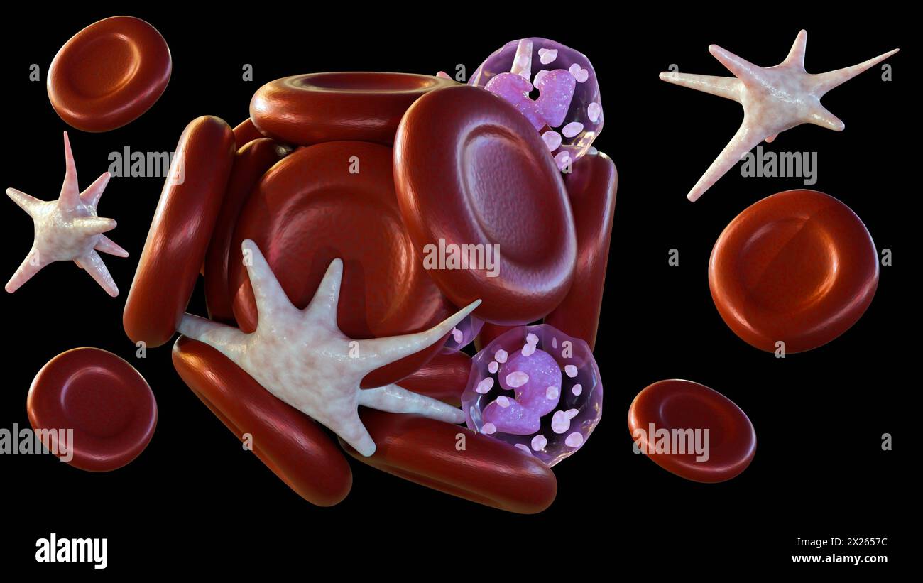 Un rendu 3D du caillot sanguin qui se déplace vers une autre partie du corps est appelé embole Banque D'Images
