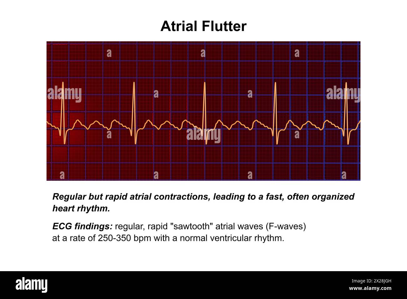 ECG dans le flutter auriculaire, illustration Banque D'Images