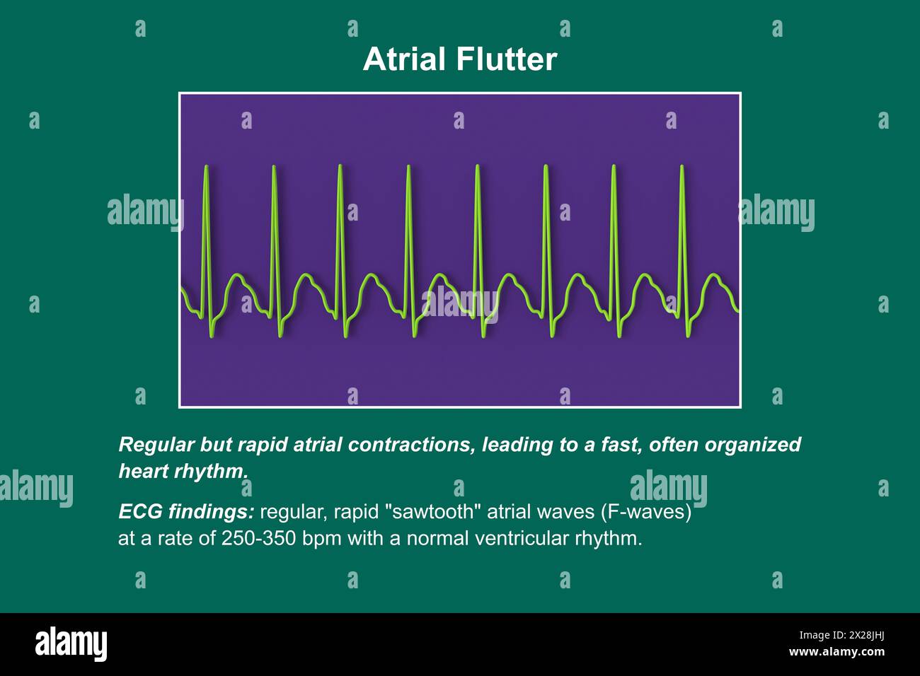 ECG dans le flutter auriculaire, illustration Banque D'Images