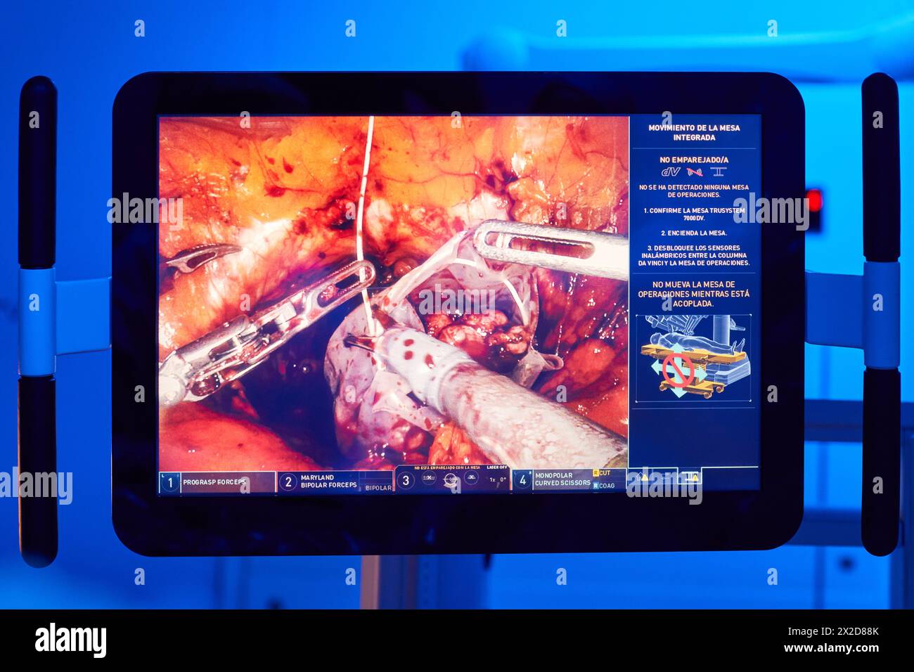 Ecran avec image interne d'une intervention chirurgicale, traitement chirurgical du cancer de la prostate, prostatectomie radicale, robot chirurgical Da Vinci, Urologie, Banque D'Images
