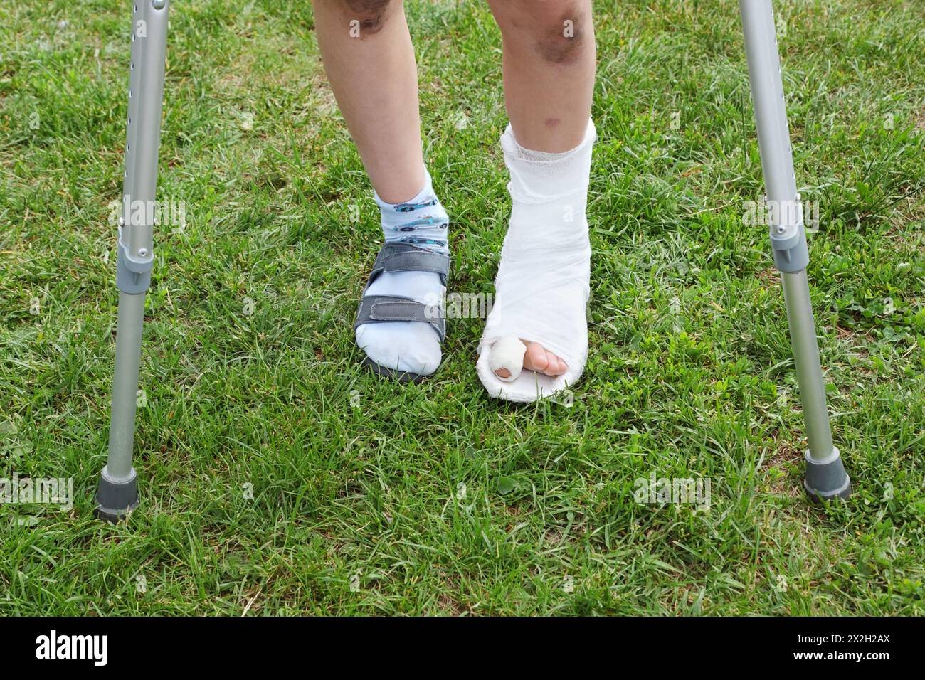 Jambes du petit garçon sur des béquilles ; jambe gauche en plâtre ; garçon debout sur l'herbe verte Banque D'Images