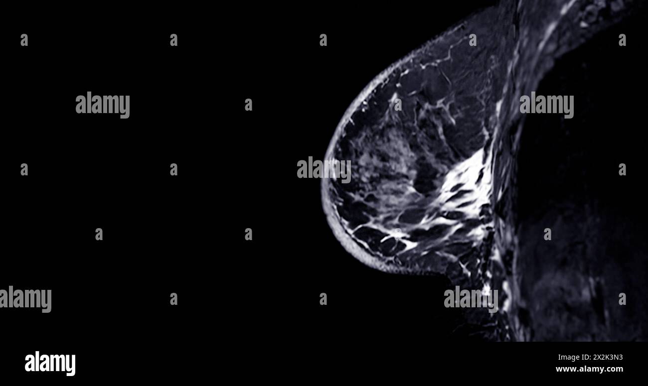 L'IRM du sein révélant BI-RADS 4 chez la femme indique des résultats suspects justifiant une investigation plus approfondie pour une tumeur maligne potentielle et une biopsie pour confirmer Banque D'Images