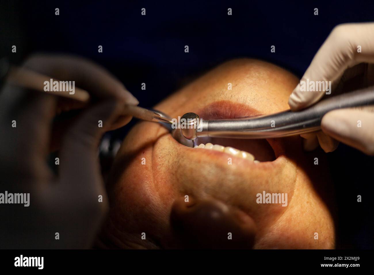 un homme adulte est vu par un dentiste, qui effectue une procédure avec une perceuse pour réparer une cavité dans une dent molaire. Banque D'Images