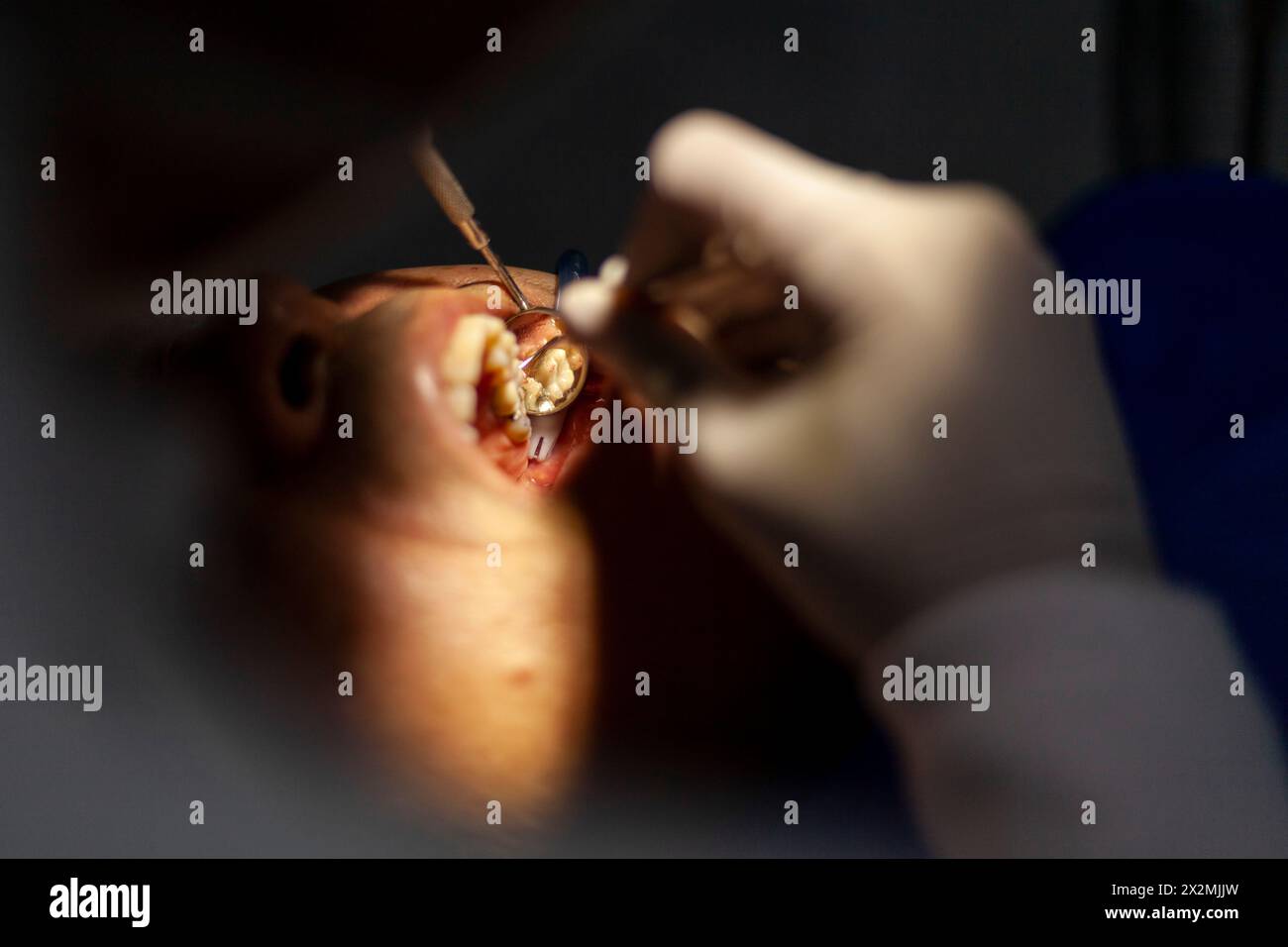 un homme adulte est vu par un dentiste, qui effectue une procédure avec une perceuse pour réparer une cavité dans une dent molaire. Banque D'Images