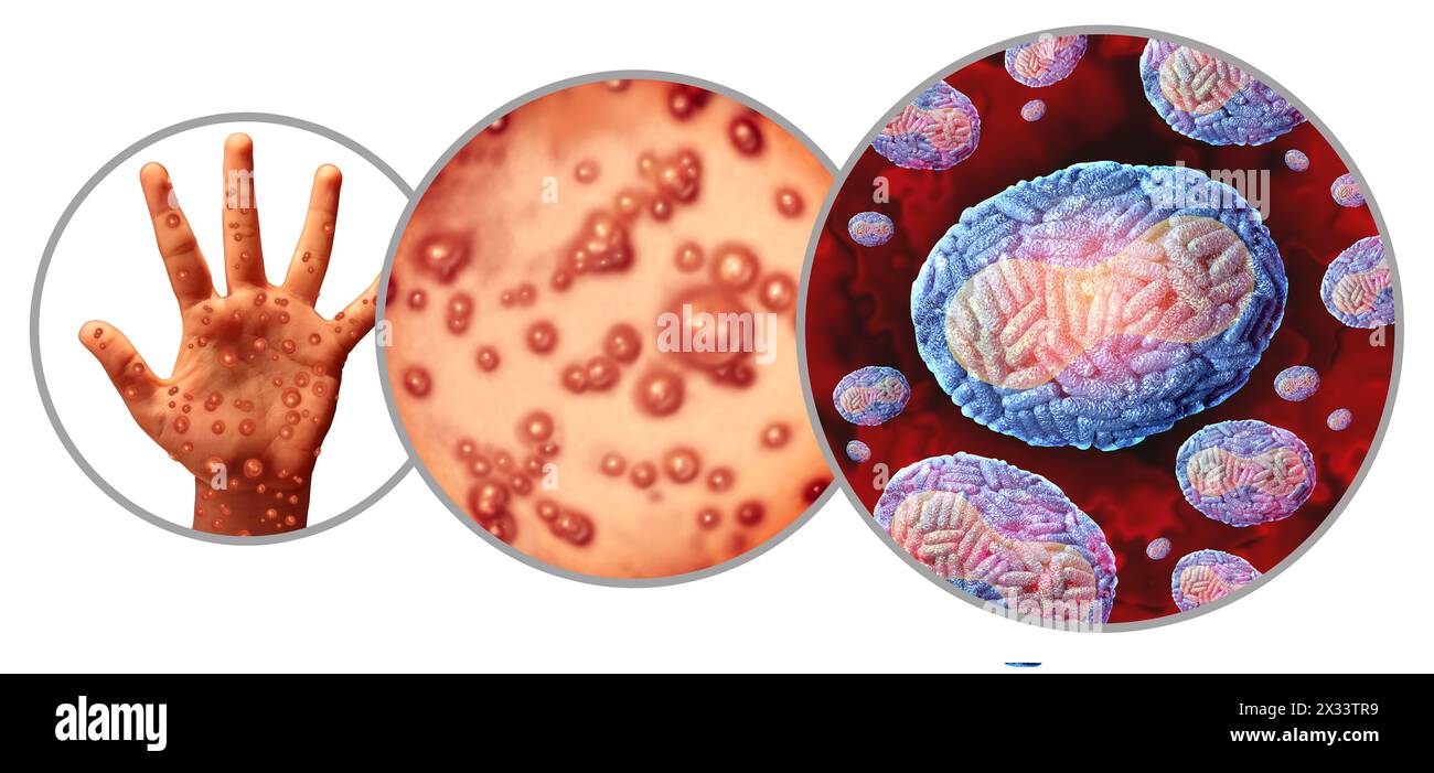 Infection par le virus de l'éclosion de la variole du singe comme une maladie contagieuse comme des cloques et des léisons sur la peau représentant la transmission d'une personne infectée. Banque D'Images Infection par le virus de l'éclosion de la variole du singe comme une maladie contagieuse comme des cloques et des léisons sur la peau représentant la transmission d'une personne infectée. Banque D'Images
