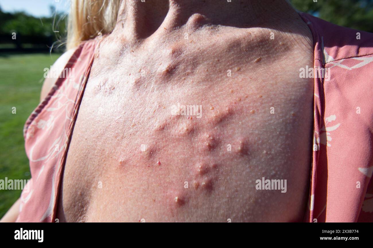 Cloques sur une femme mordue par des fourmis de feu (solenopsis sp) alors qu'elle jardinait dans un jardin de banlieue près de Brisbane, Queensland, Queensland, Queensland, Australie Banque D'Images Cloques sur une femme mordue par des fourmis de feu (solenopsis sp) alors qu'elle jardinait dans un jardin de banlieue près de Brisbane, Queensland, Queensland, Queensland, Australie Banque D'Images