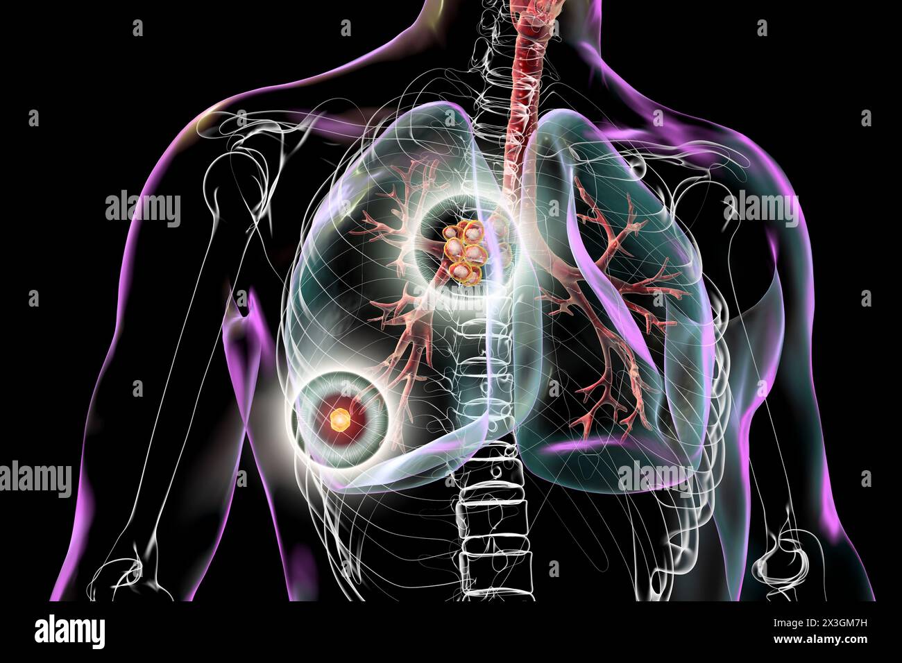 Illustration d'une tuberculose pulmonaire primitive avec le complexe de Ranke, mettant en évidence des lésions pulmonaires et des adénites médiastinales. Banque D'Images