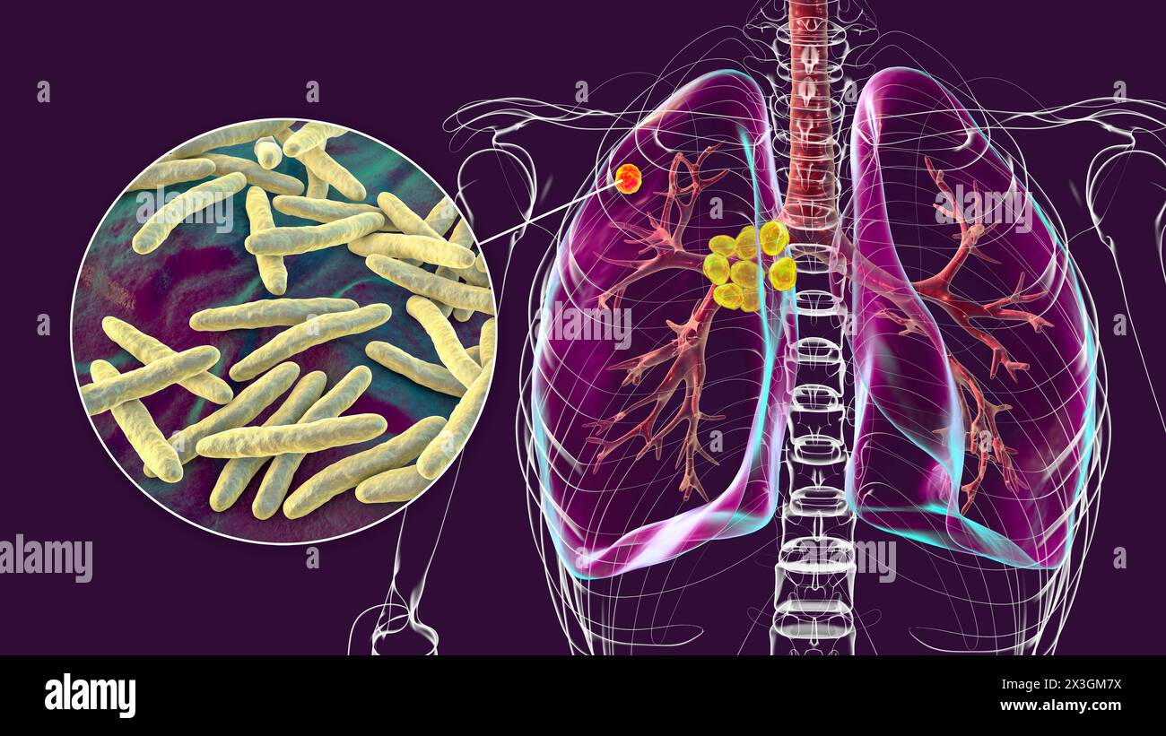 Tuberculose pulmonaire primaire Banque de photographies et d’images à ...