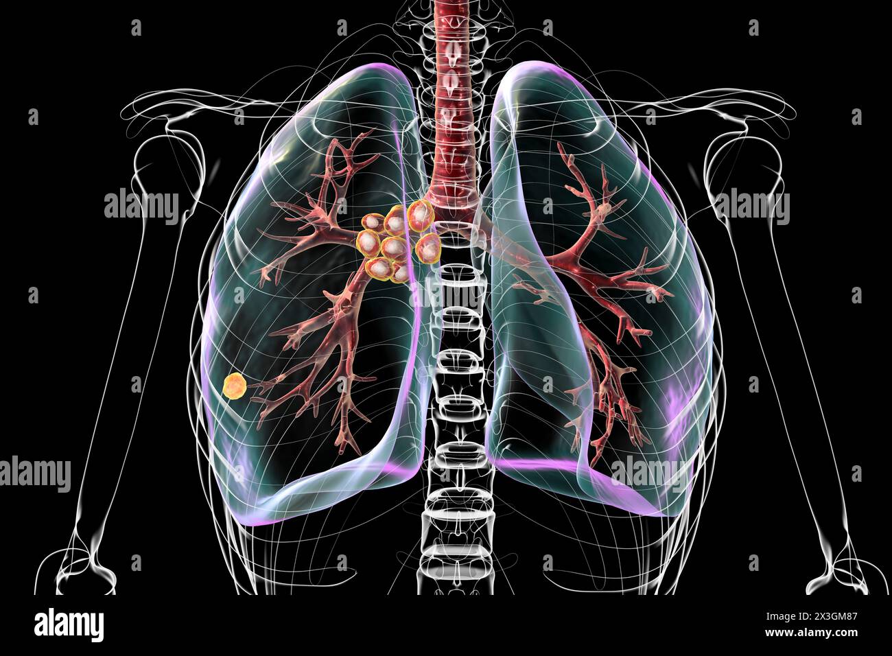 Illustration d'une tuberculose pulmonaire primitive avec le complexe de Ranke, mettant en évidence des lésions pulmonaires et des adénites médiastinales. Banque D'Images